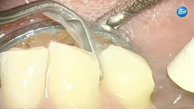 komet-dental-sonicline-video-kronenstumpf-pr-paration-agabiti-2 image 1