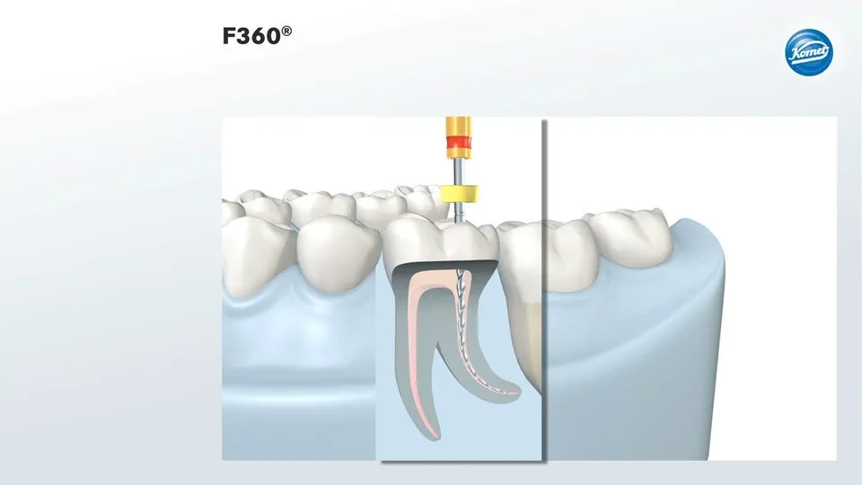 komet-dental-f360-animation-video-endo-schulung image 1