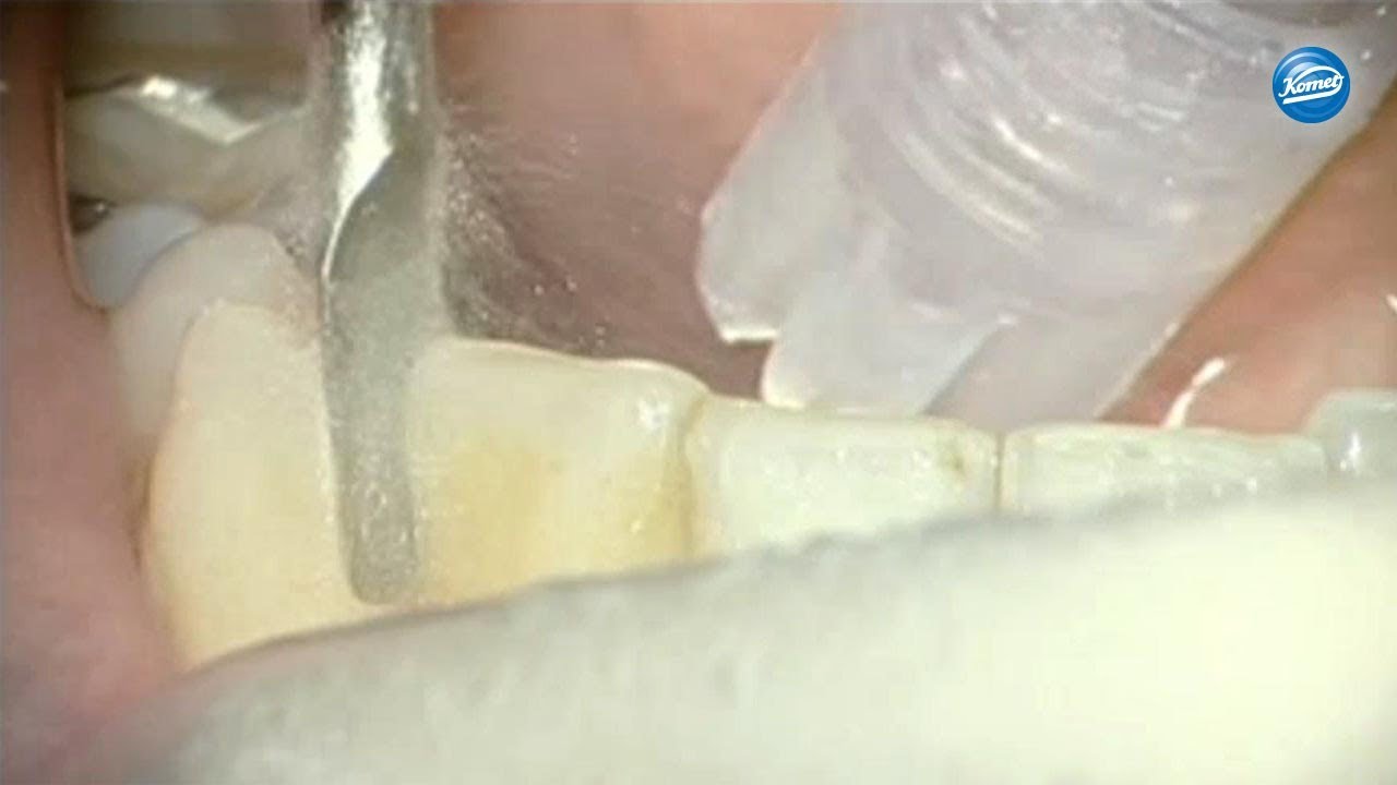komet-diao-video-proximale-schmelzreduktion-kieferorthop-die image 1