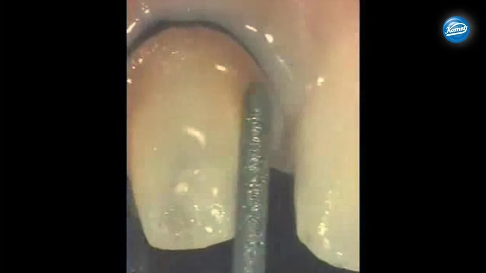 komet-dental-sonicline-video-kronenstumpf-pr-paration-massironi image 1