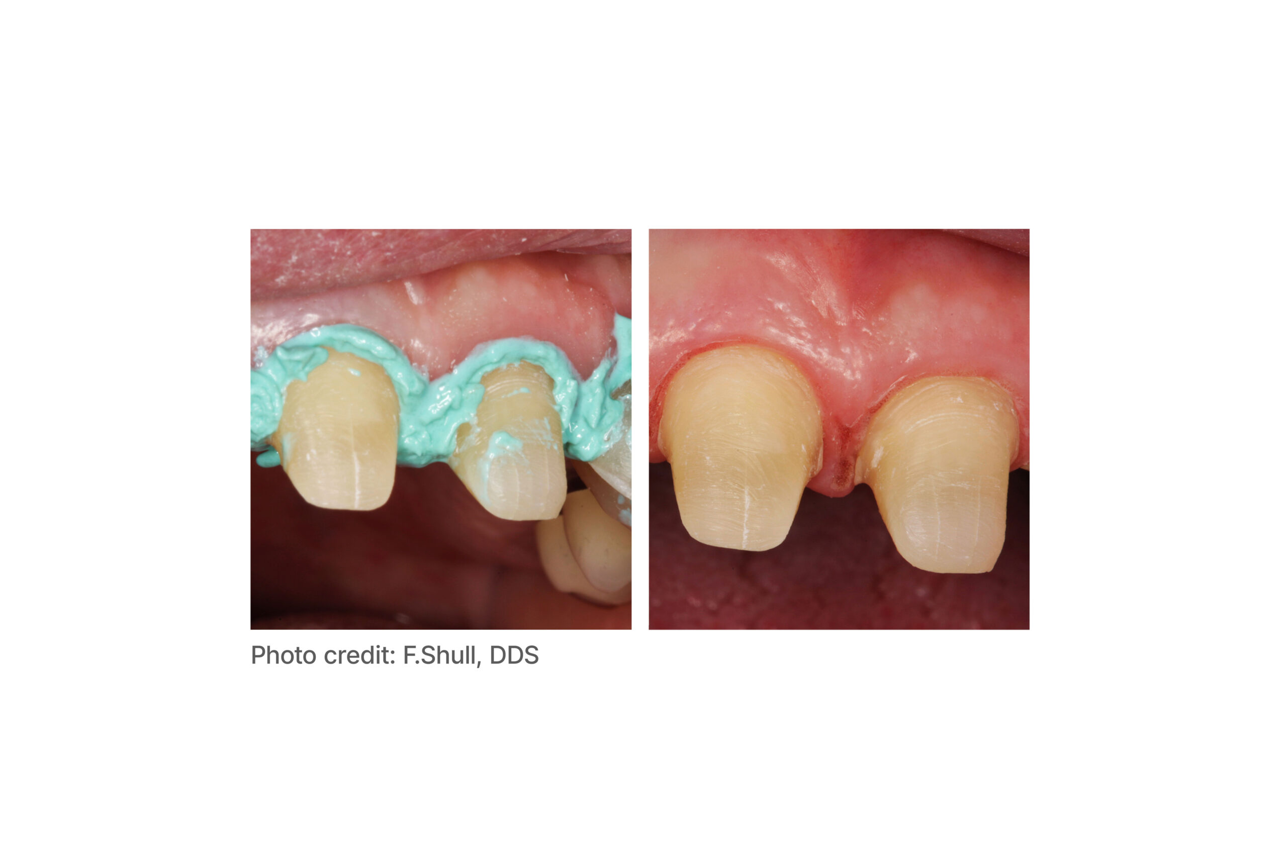 parkell-dryz-blu-retraktionspaste-h-mostatisch-aluminiumchlorid-23 image 2