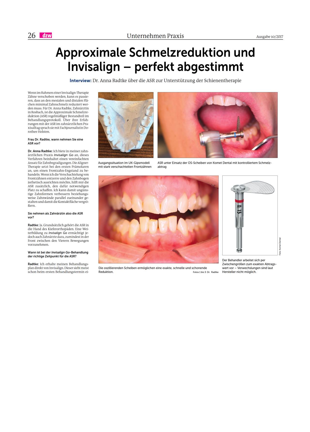 komet-diao-fachbericht-schmelzreduktion-asr-invisalign image 1