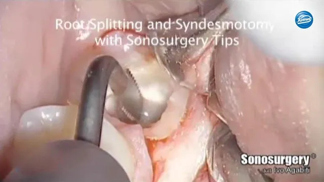 komet-dental-diao-video-weisheitszahn-entfernung-agabiti image 1
