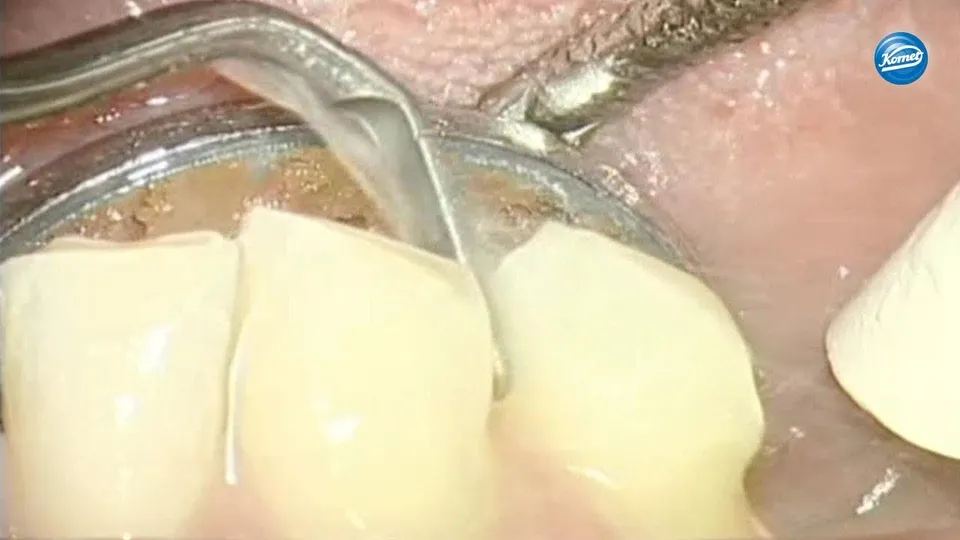 komet-dental-sonicline-lehrvideo-kronenpr-paration-russisch image 1