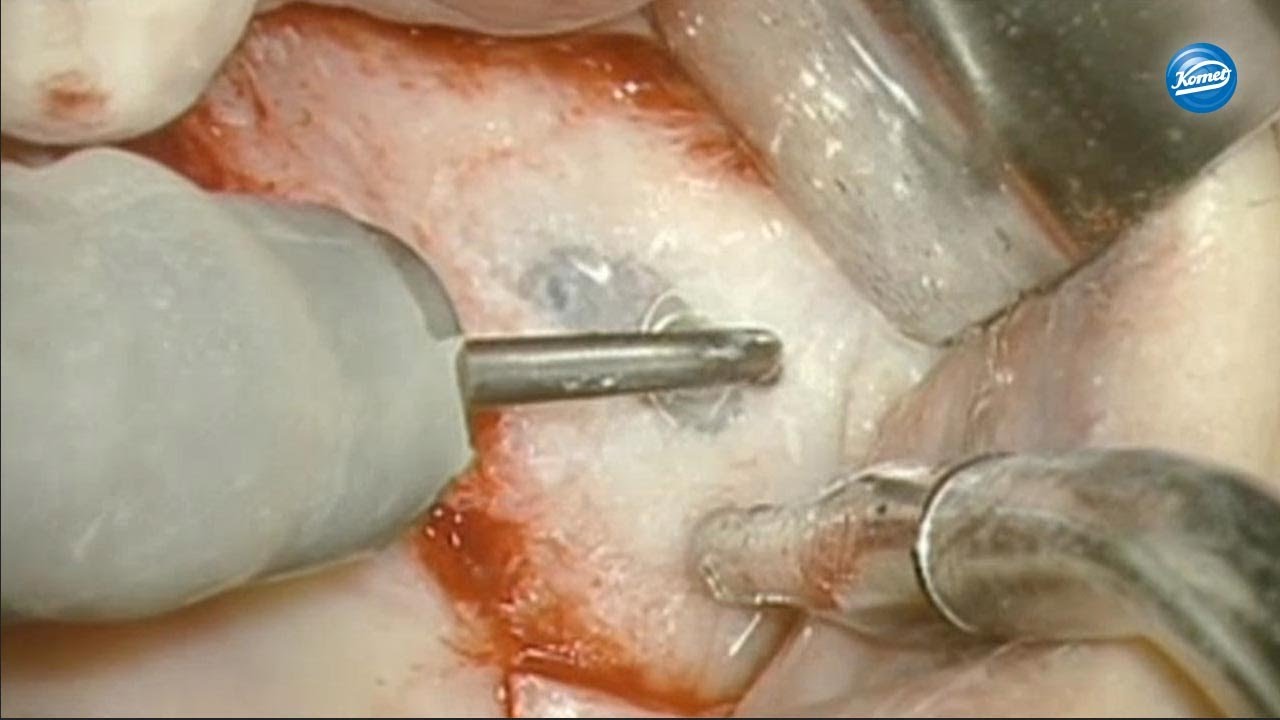 komet-sonicline-schallspitzen-video-sinuslift image 1