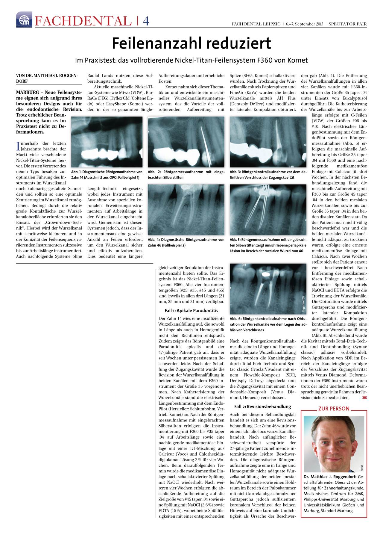komet-f360-fachbericht-nickel-titan-feilen-vollrotierend image 1
