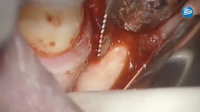 komet-ceradrill-video-intraorale-knochenbl-cke-schallspitzen image 1