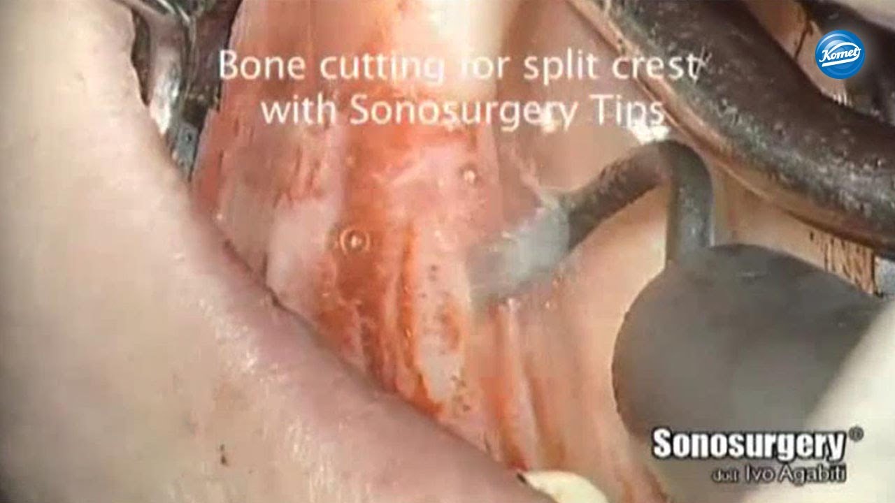 komet-dental-diao-kieferkammspreitzung-video-dr-agabiti image 1