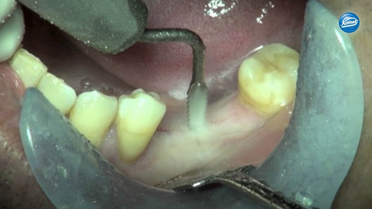 komet-diao-video-alveolarfortsatz-spreizung-sonochirurgie image 1