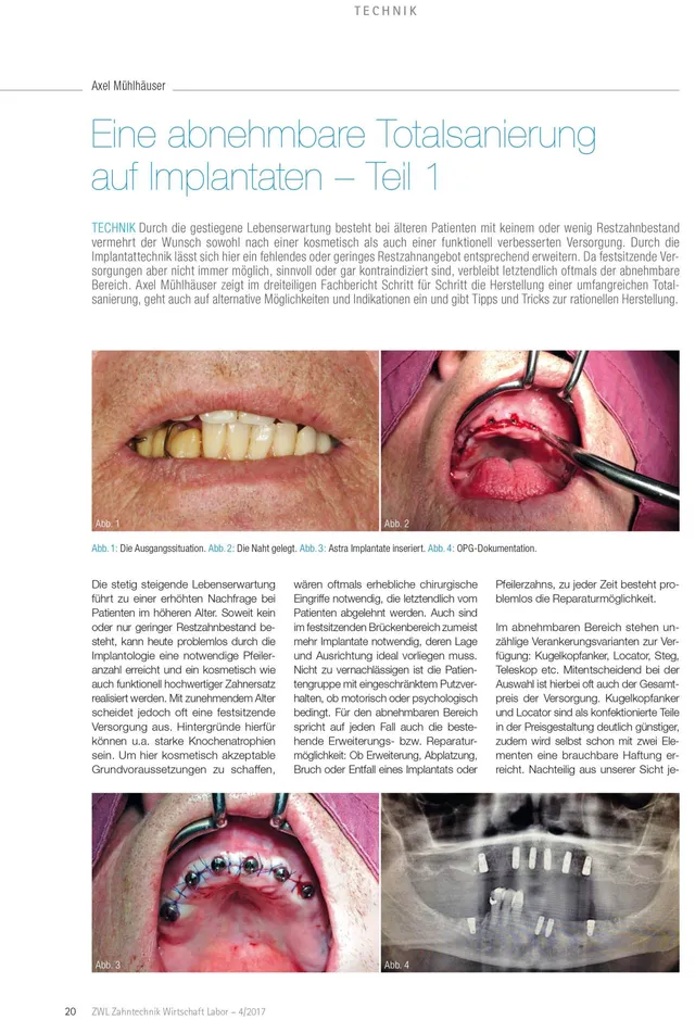 komet-dental-ceradrill-fachbeitrag-totalsanierung-implantat-teil-1 image 1